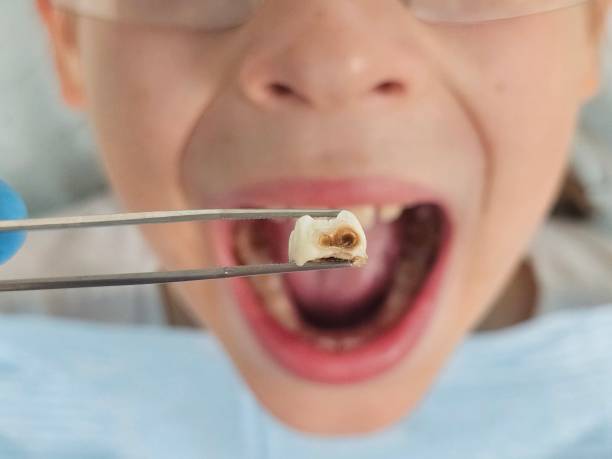 Best Knocked-Out Tooth (Avulsed Tooth) Treatment in Moses Lake, WA